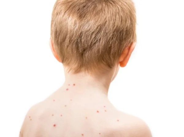 A Vacina contra a Varicela