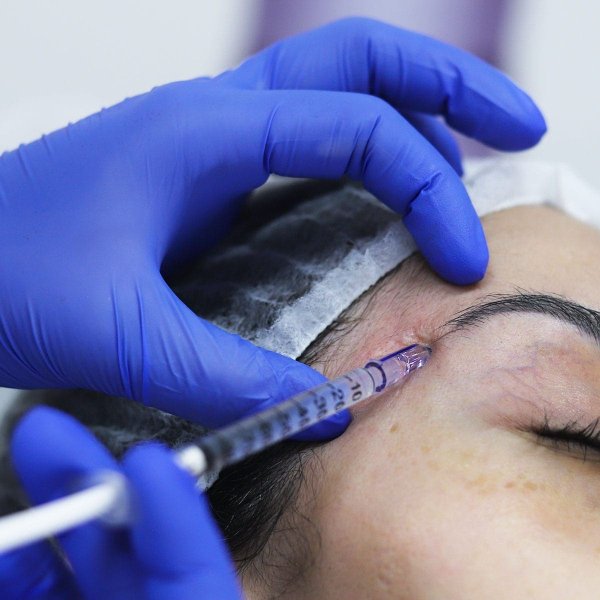 Smart Mesofill 0,6mm - Cartucho com 3 microagulhas - Caixa com 05un