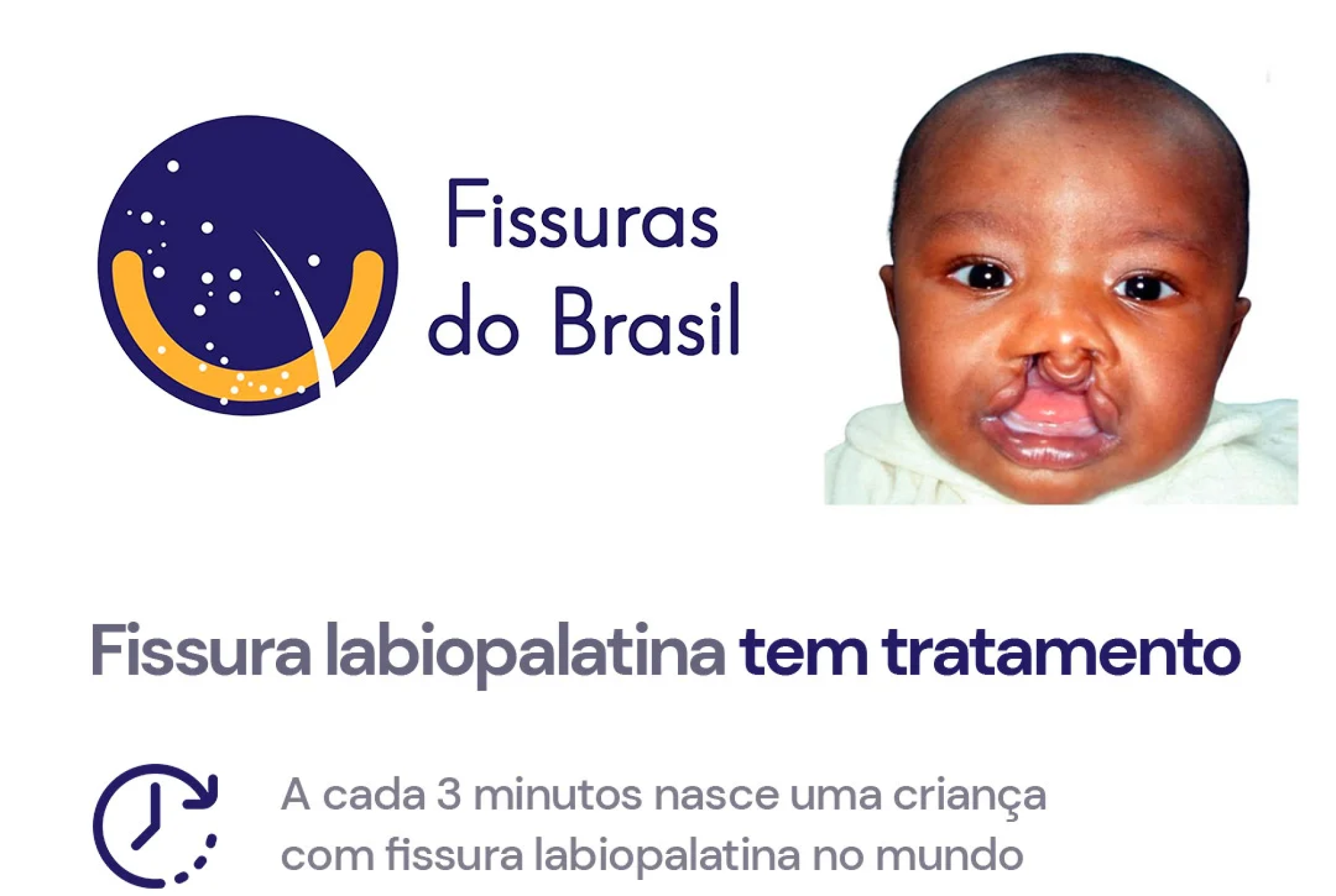 Fissura labiopalatina tem tratamento