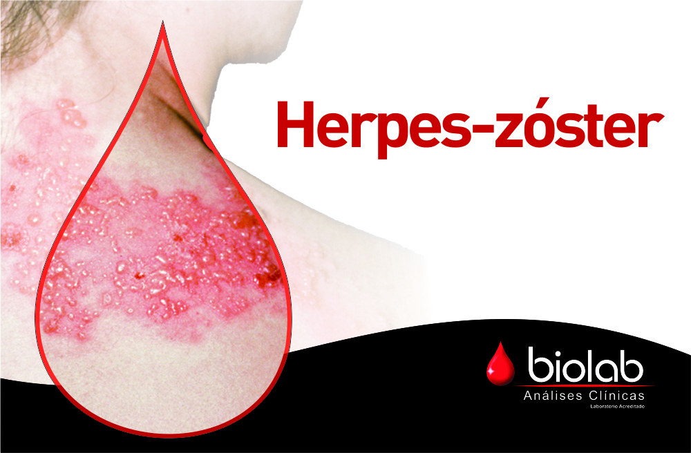 Saiba mais sobre o Herpes-zster