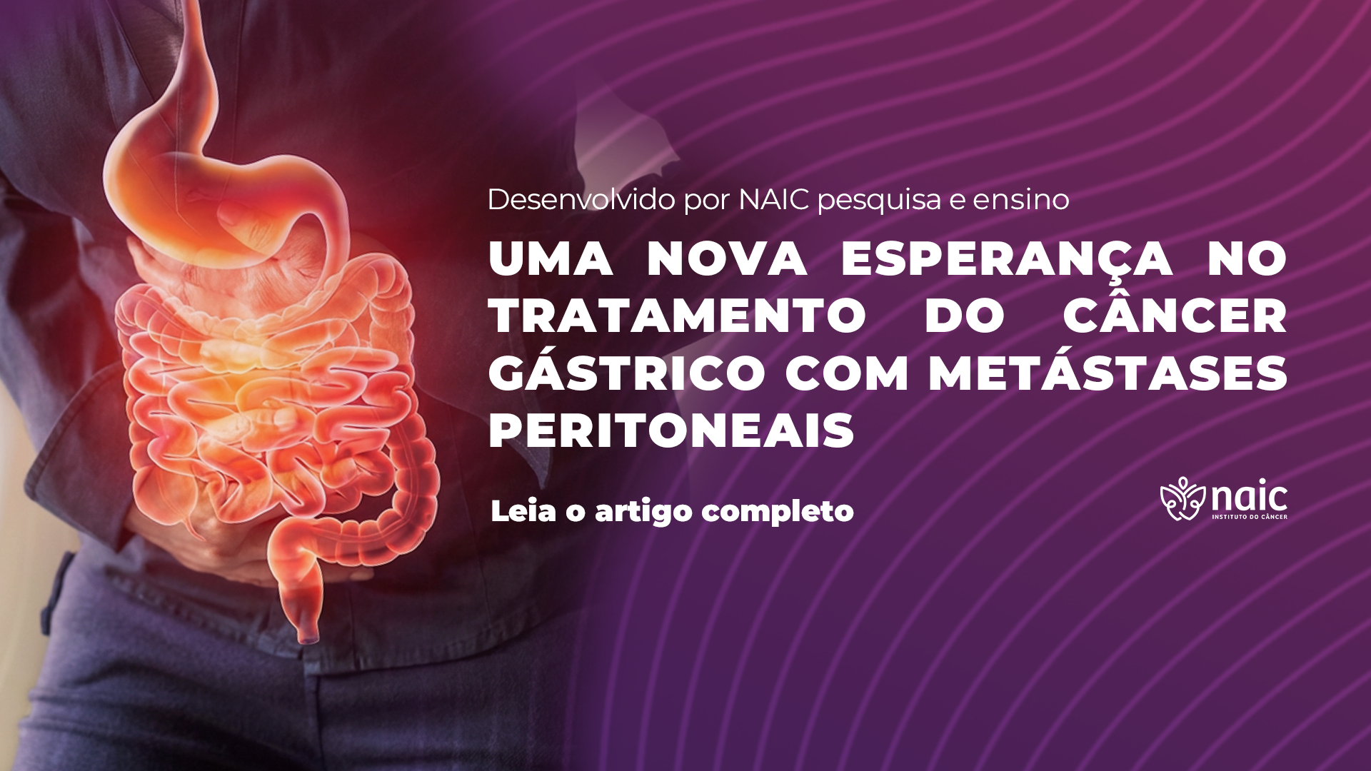 Uma Nova Esperan�a no Tratamento do C�ncer G�strico com Met�stases Peritoneais: An�lise do Estudo CYTO-CHIP