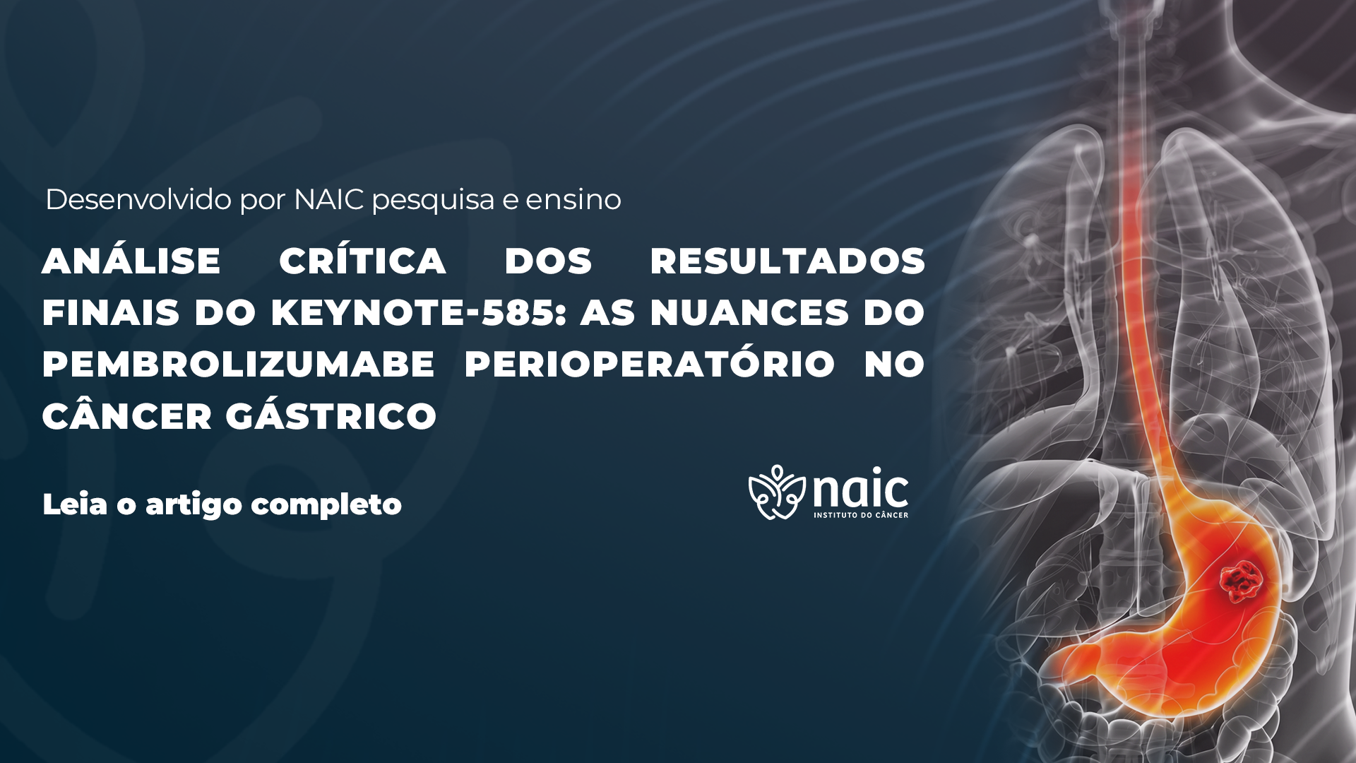 An�lise Cr�tica dos Resultados Finais do KEYNOTE-585: As Nuances do Pembrolizumabe Perioperat�rio no C�ncer G�strico